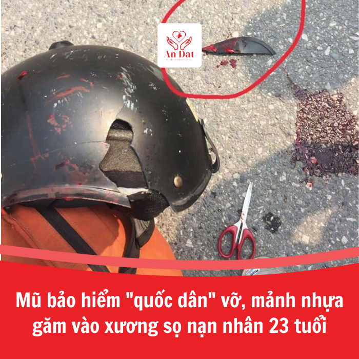 Mũ bảo hiểm “quốc dân” vỡ, mảnh nhựa găm vào xương sọ nạn nhân 23 tuổi